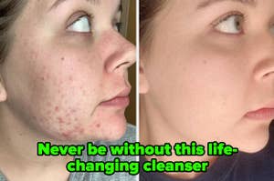 L: a reviewer with acne along their jaw, R: the same reviewer with their acne cleared and text reading "Never be without this life-changing cleanser"
