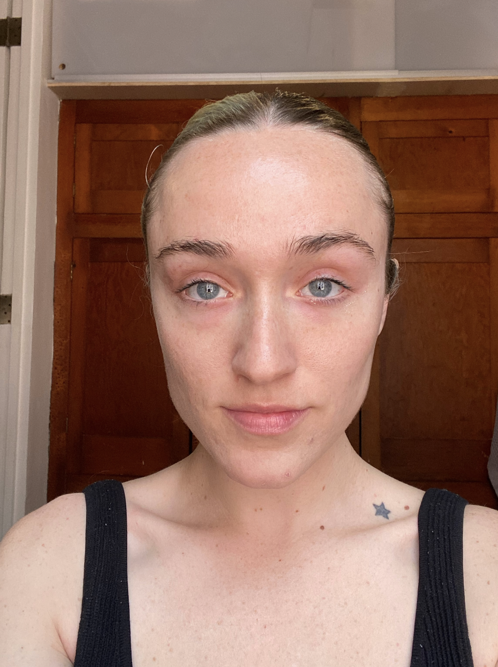 The author after the treatment with a smoother under eye area
