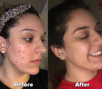 Before and after image of reviewer with cystic acne and without