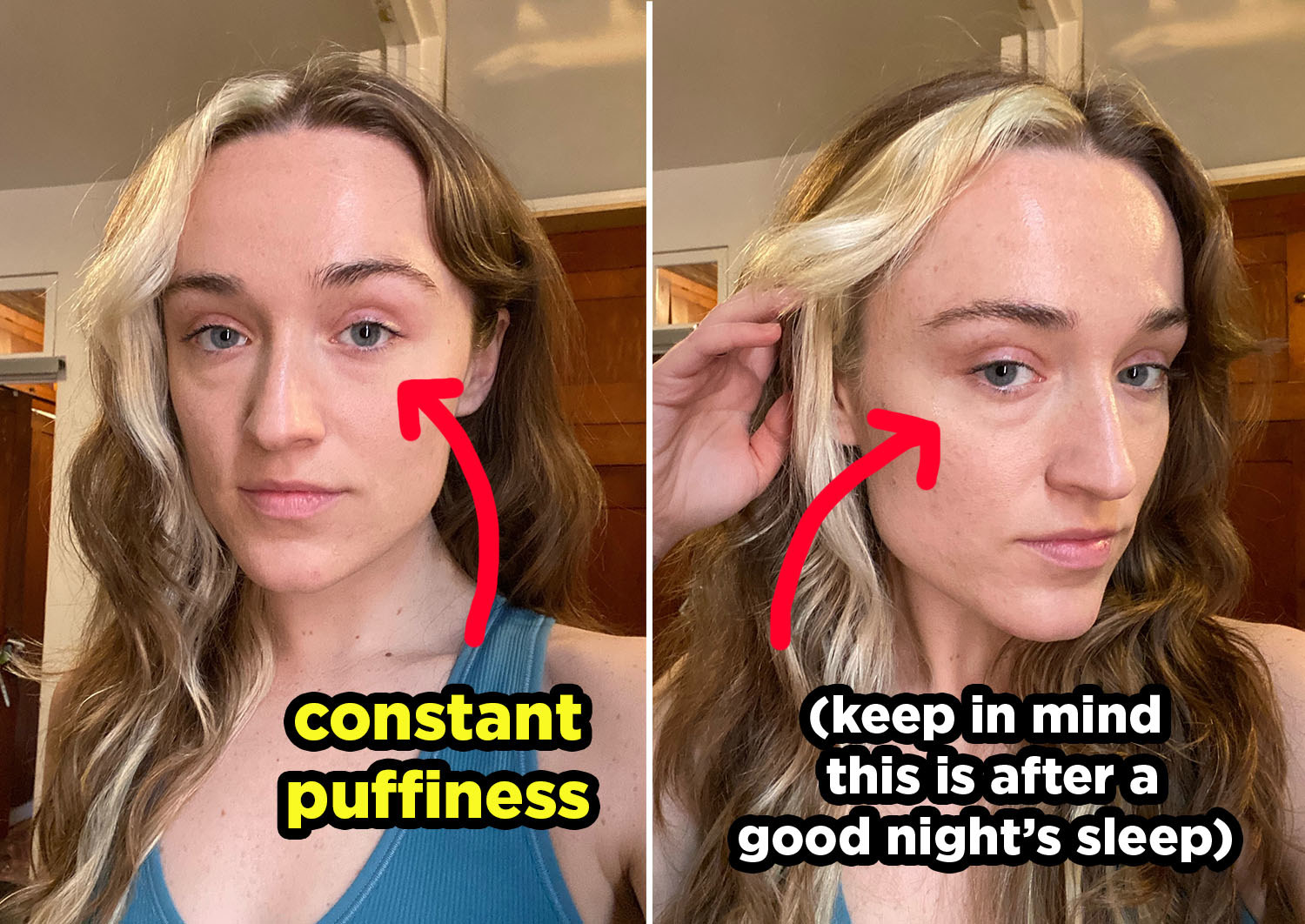 8 Tricks To Fix Puffy Eyes In An Instant, Because Bags Happen To All –  StyleCaster