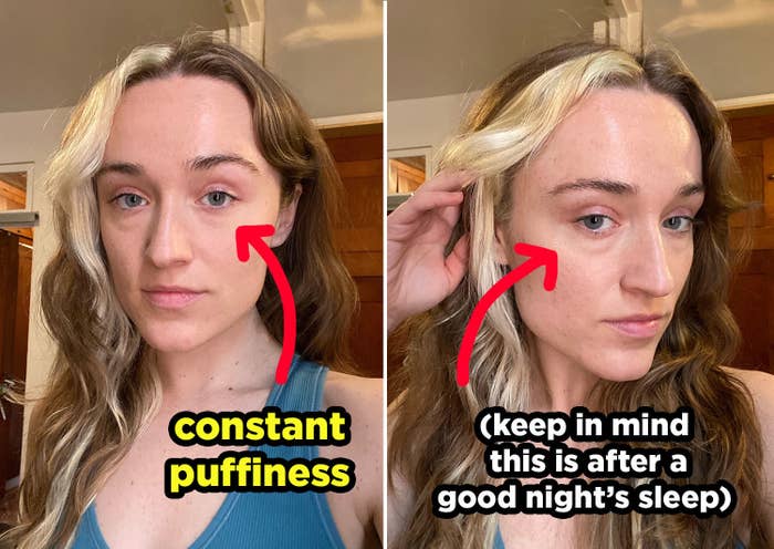The author&#x27;s face with arrows pointing to the area under her eyes and the words &quot;constant puffiness&quot; and &quot;(keep in mind this is after a good night&#x27;s sleep)&quot;