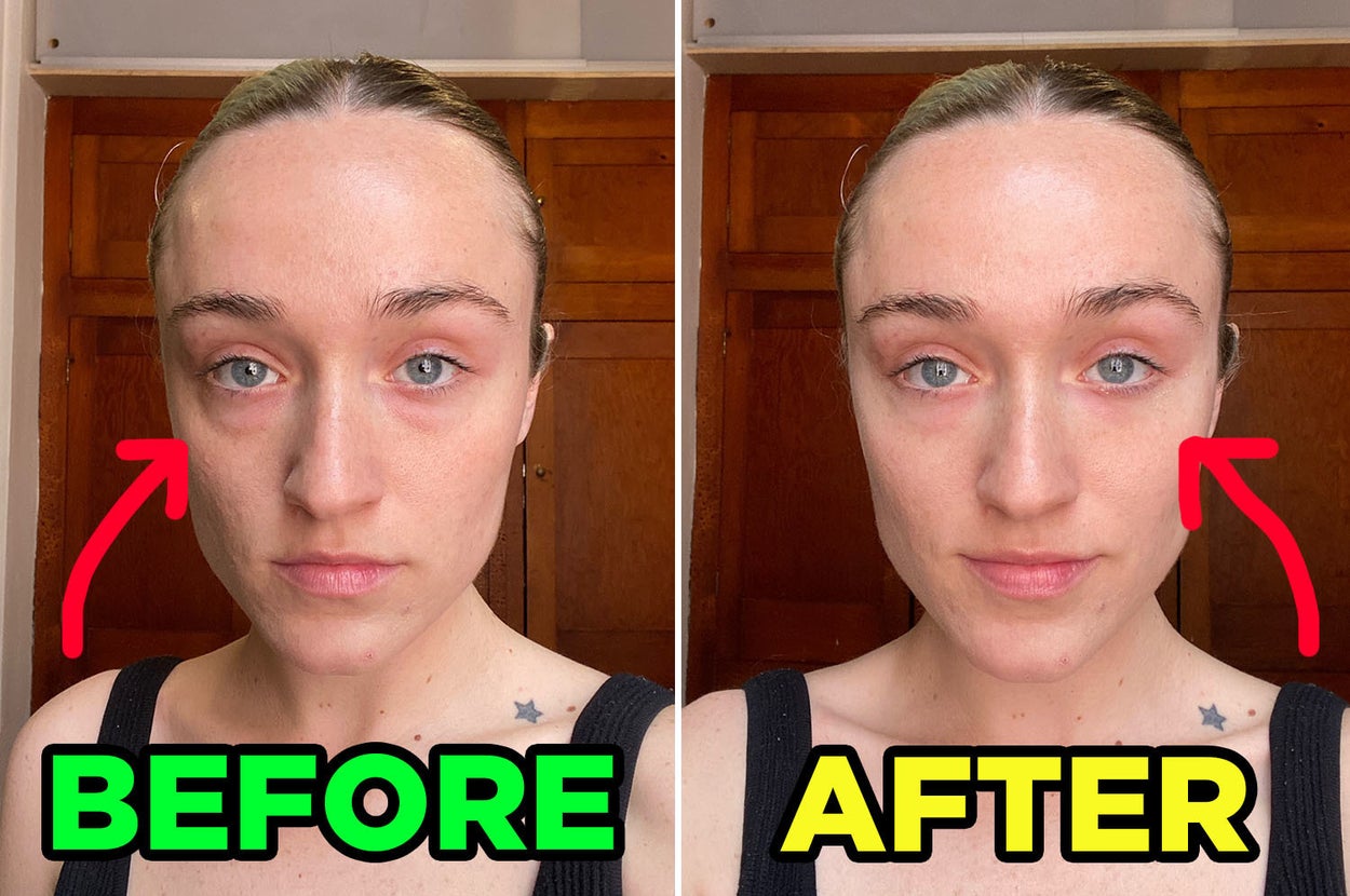 A before and after of an eye bag cream treatment