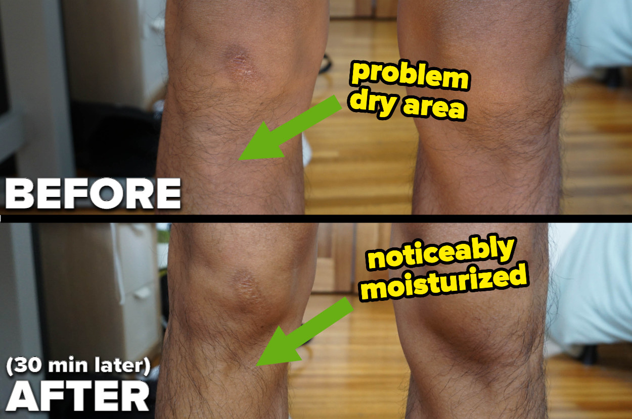 before and after of the author&#x27;s knees looking noticeably moisturized afterward