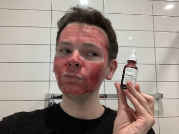 BuzzFeed writer after applying Ordinary peeling solution