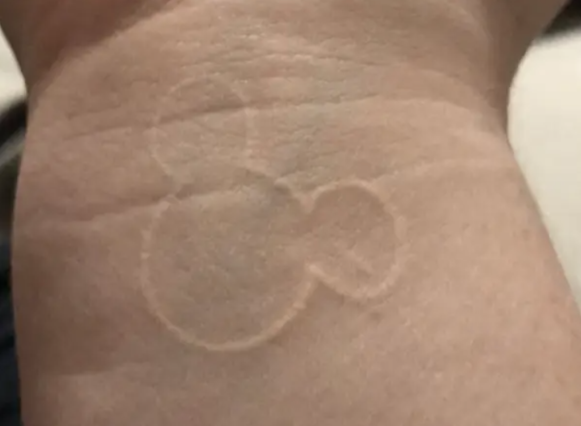 A Mickey Mouse silhouette tattoo in white on someone&#x27;s wrist