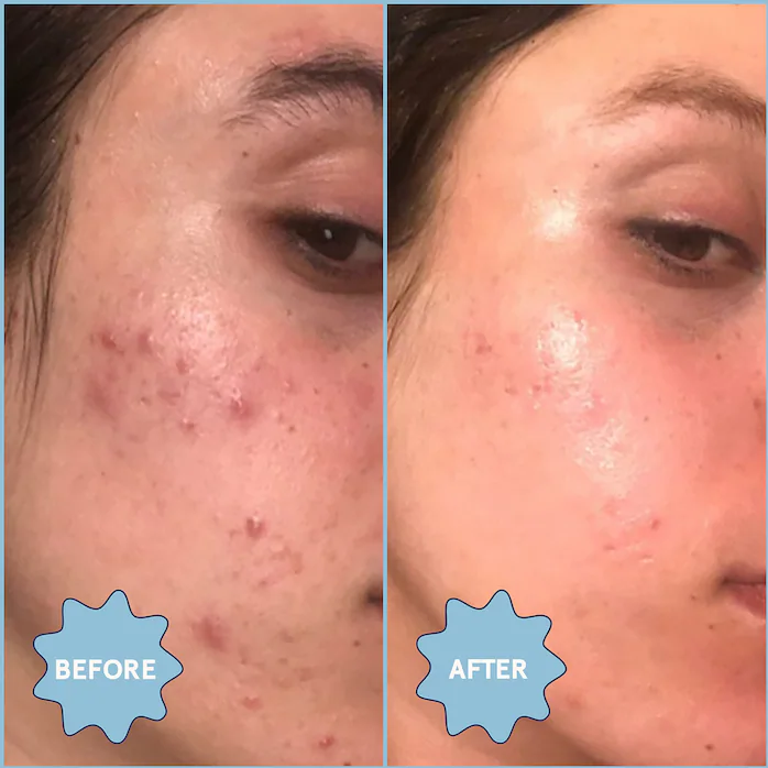 A before image of a person with acne on their face and an after image of their face with smoother, less irritated skin