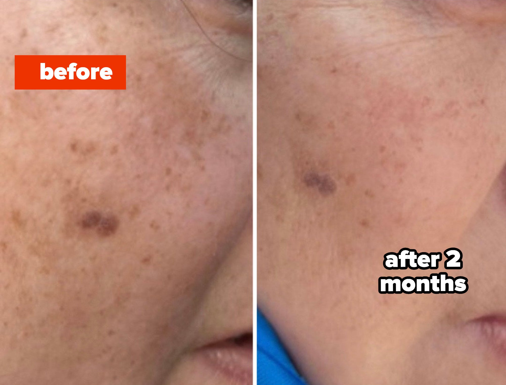 a before and after where the after shows noticeably smoother skin with less hyperpigmentation