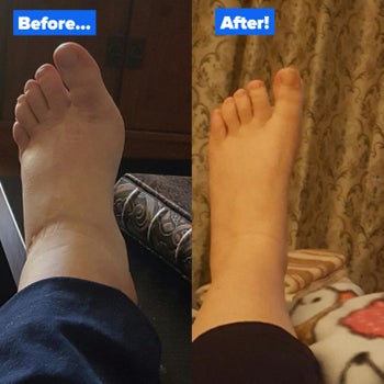before and after photos of a reviewer's foot looking very swollen before using the socks, and much less swollen after