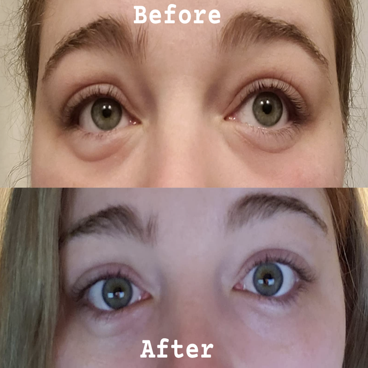 reviewer showing before photo with puffy eyes and after photo with less puffy eyes