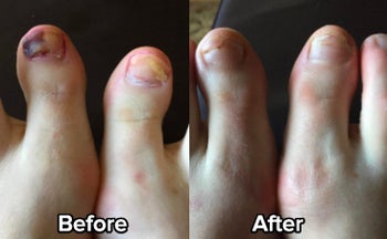 Reviewer's big toes with dark and light spots of fungal growth before. The toenails are growing back and looking healthier after use. 