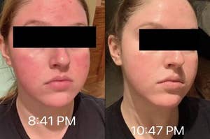 before and after photo of reviewer on left with visibly red skin labeled "8:41pm" and on right, visibly less red skin labeled "10:47pm" 