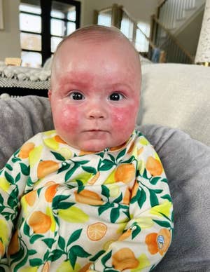 Kayzie's baby's face is covered in a bright red rash