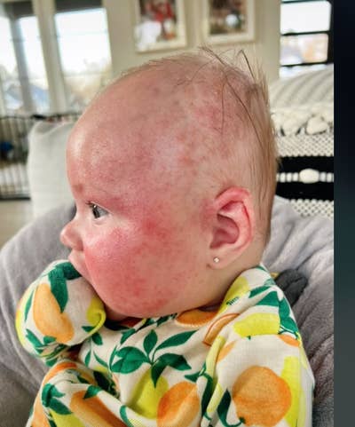 A profile picture of Kayzie's baby, showing the rash extends all the way to the back of the baby's head