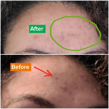 Reviewer image of forehead before and after using face wash