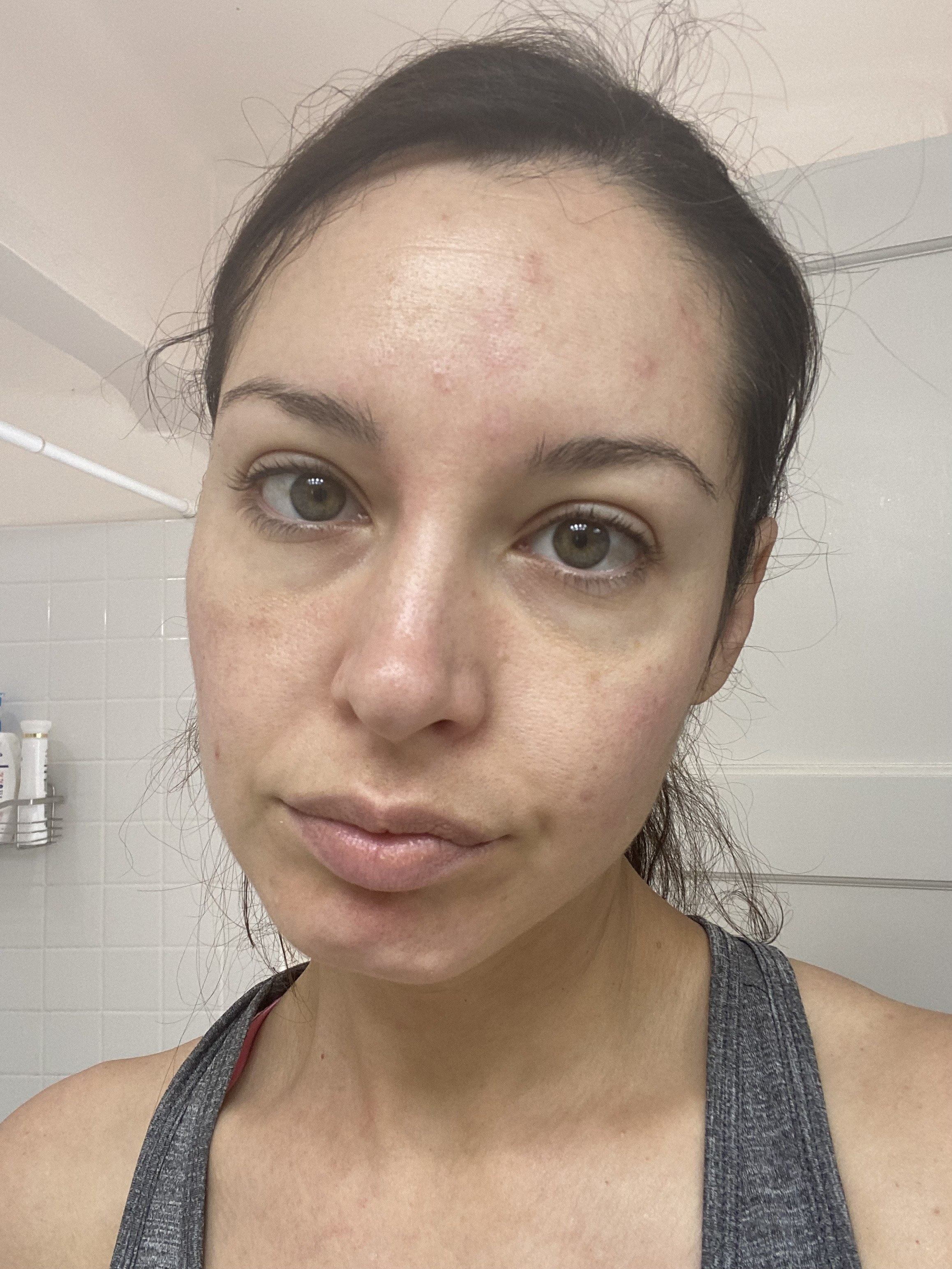 I Developed Rosacea And Hyperpigmentation After Laser Treatment