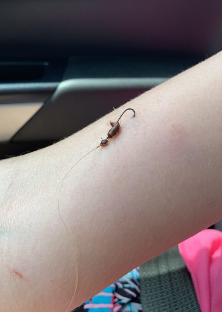 A fish hook in someone&#x27;s arm