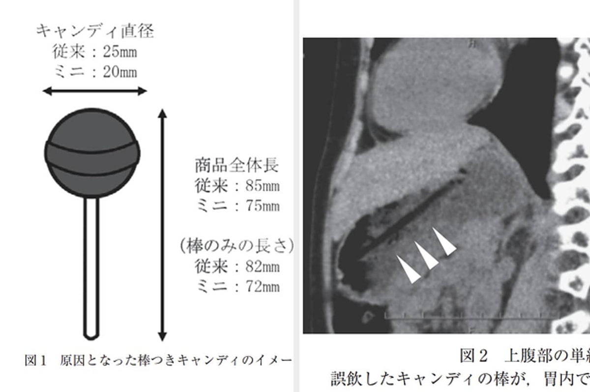 5歳児があくびの瞬間に 棒つきキャンディ を丸ごと誤飲 事故の予防策ともしもの対処法は 小児科学会の発表は