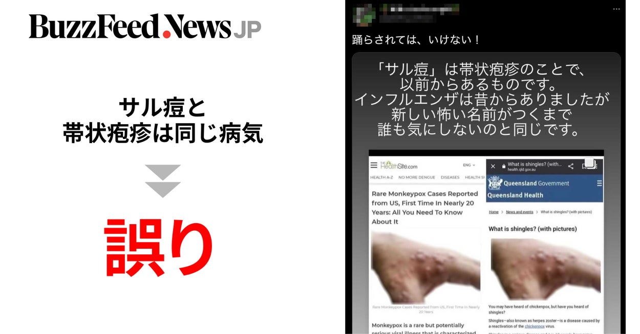 Image accompanying 「サル痘と帯状疱疹は同じ病気」