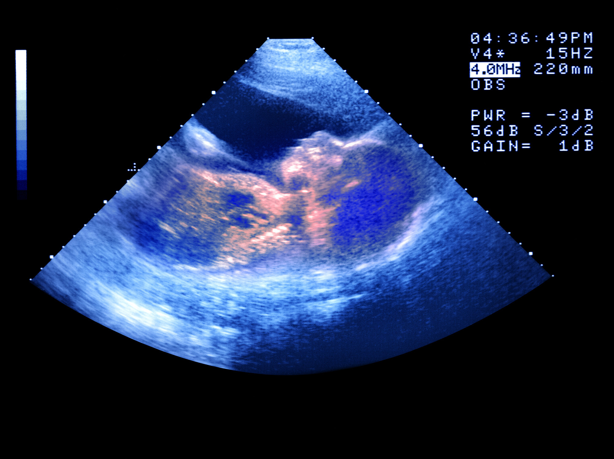 An ultrasound pic of a baby