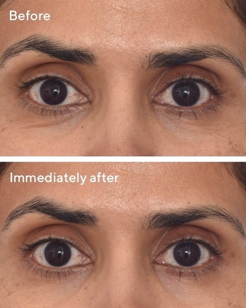 Before-and-after results of using Murad retinol eye patches