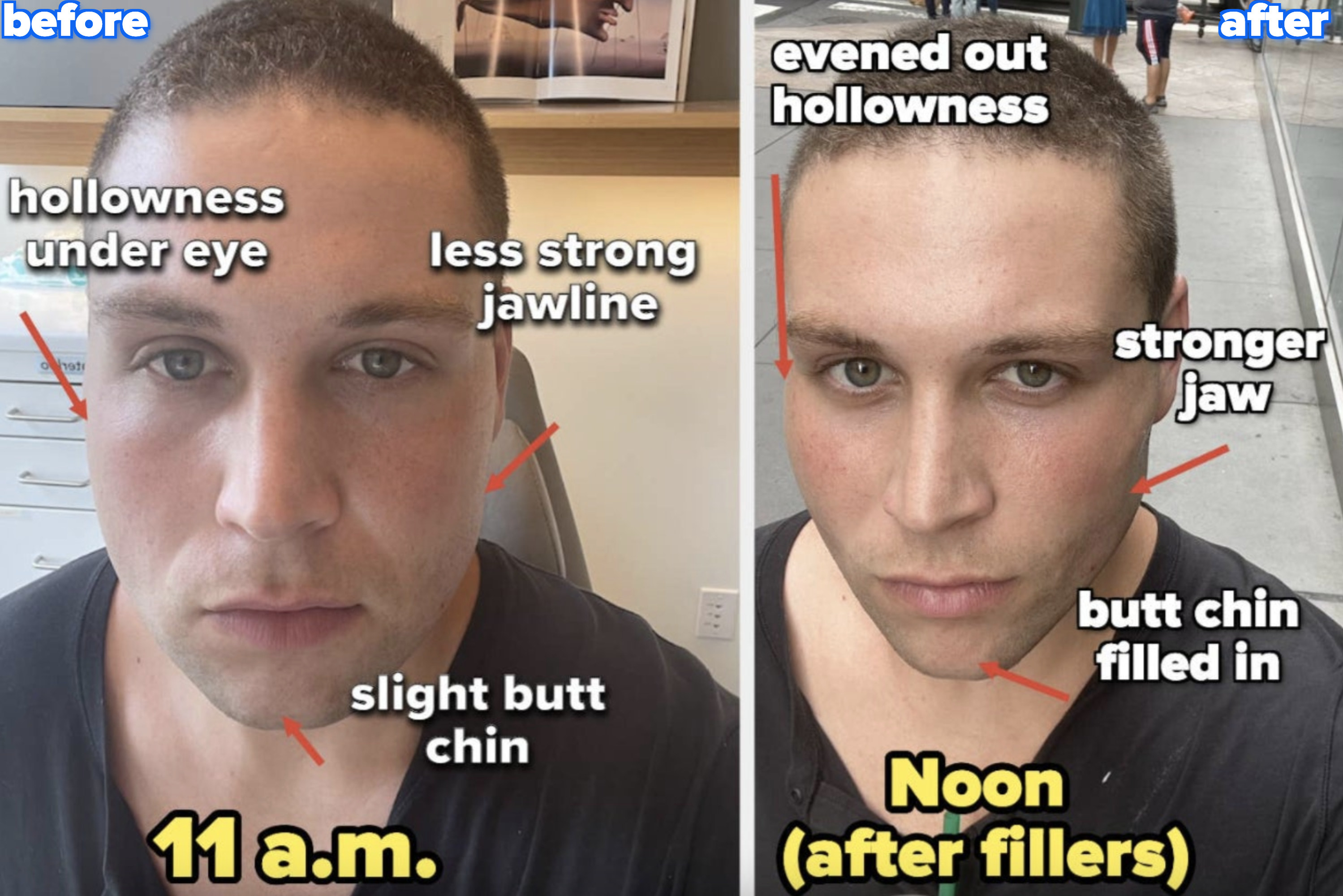 Before at 11 am: hollowness under eye, less strong jawline, and slight butt chin; after fillers at noon: evened out eye hollowness, stronger jaw, butt chin filled in
