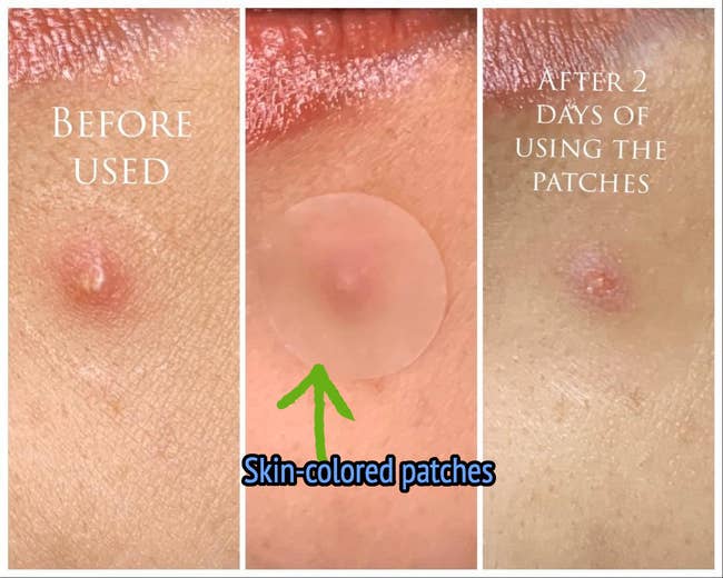 Reviewer image of person before, using pimple patch, and after with less red pimple