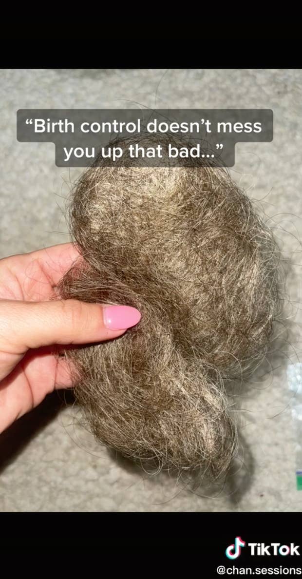 If You Take Birth Control For As Long As I Did And Stop, Your Body Can Go  Into A Hormonal Shock And Trigger Autoimmune Disease Responses: This Woman  Experienced Extreme Hair Loss
