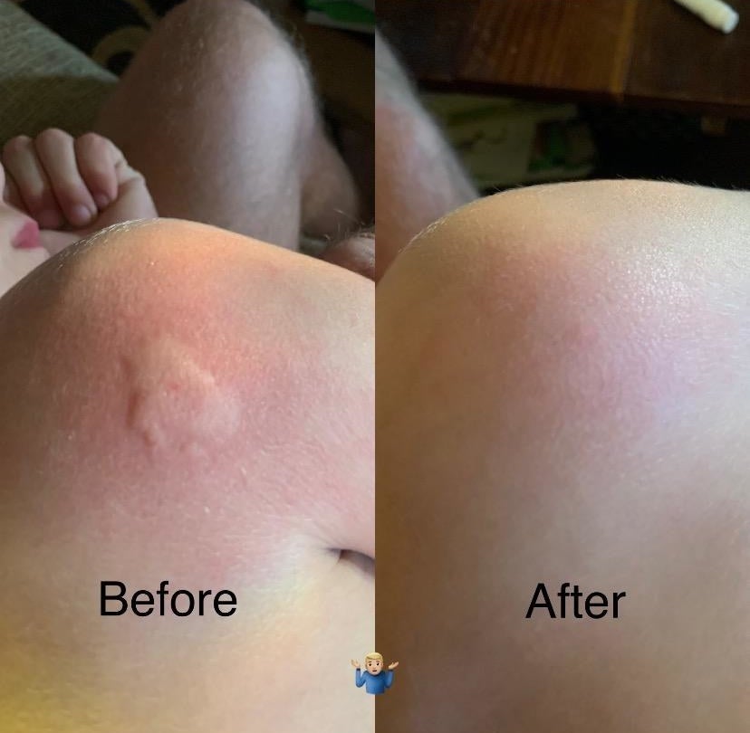 Reviewer&#x27;s photo of a bug bite, before and after using the Bug Bite Thing
