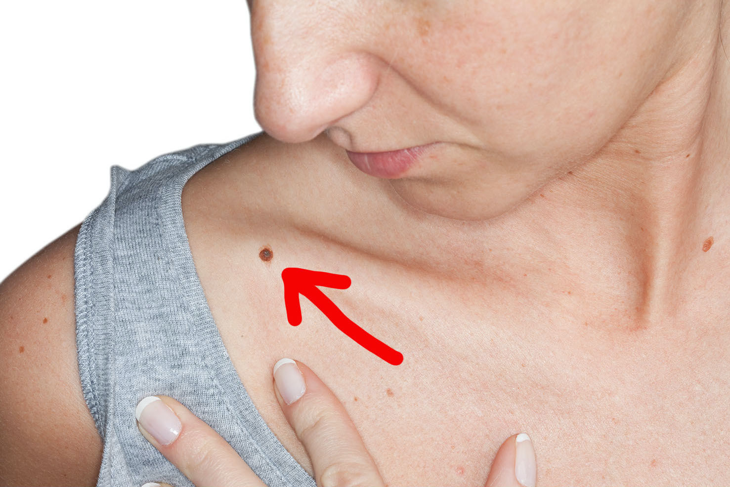 Arrow pointing to a mole on someone&#x27;s clavicle