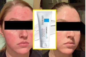 a reviewer showing show their face was red and irritated and then nice and calm after using la roche posay balm