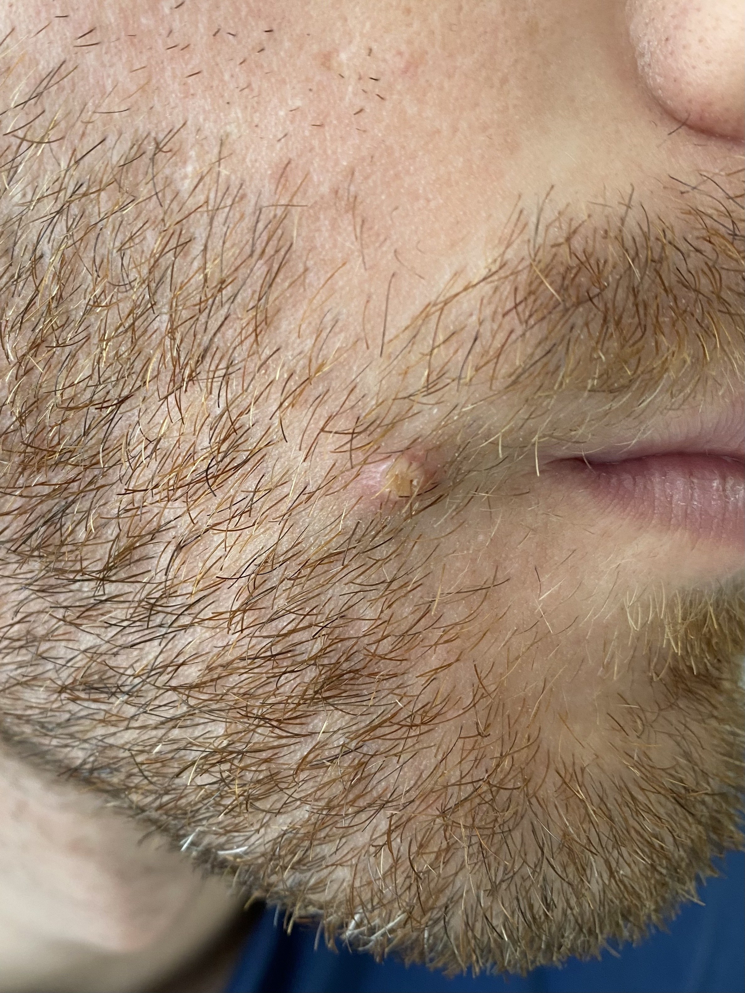 Pus-filled monkeypox pockmark on the author&#x27;s cheek