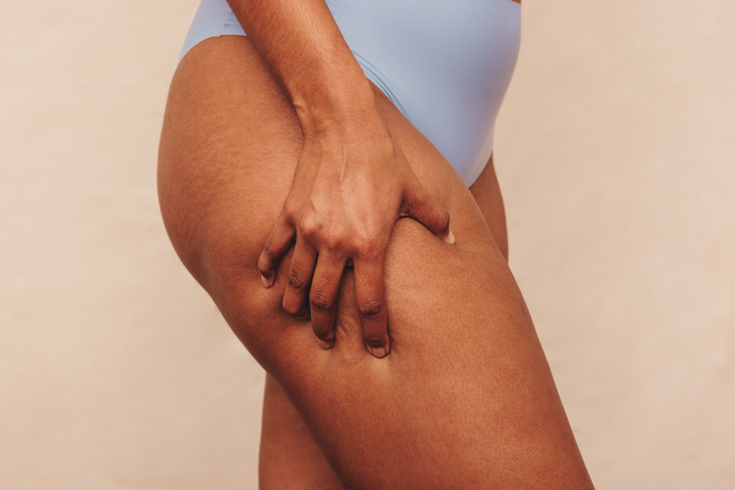 Woman with cellulite holding her thighs