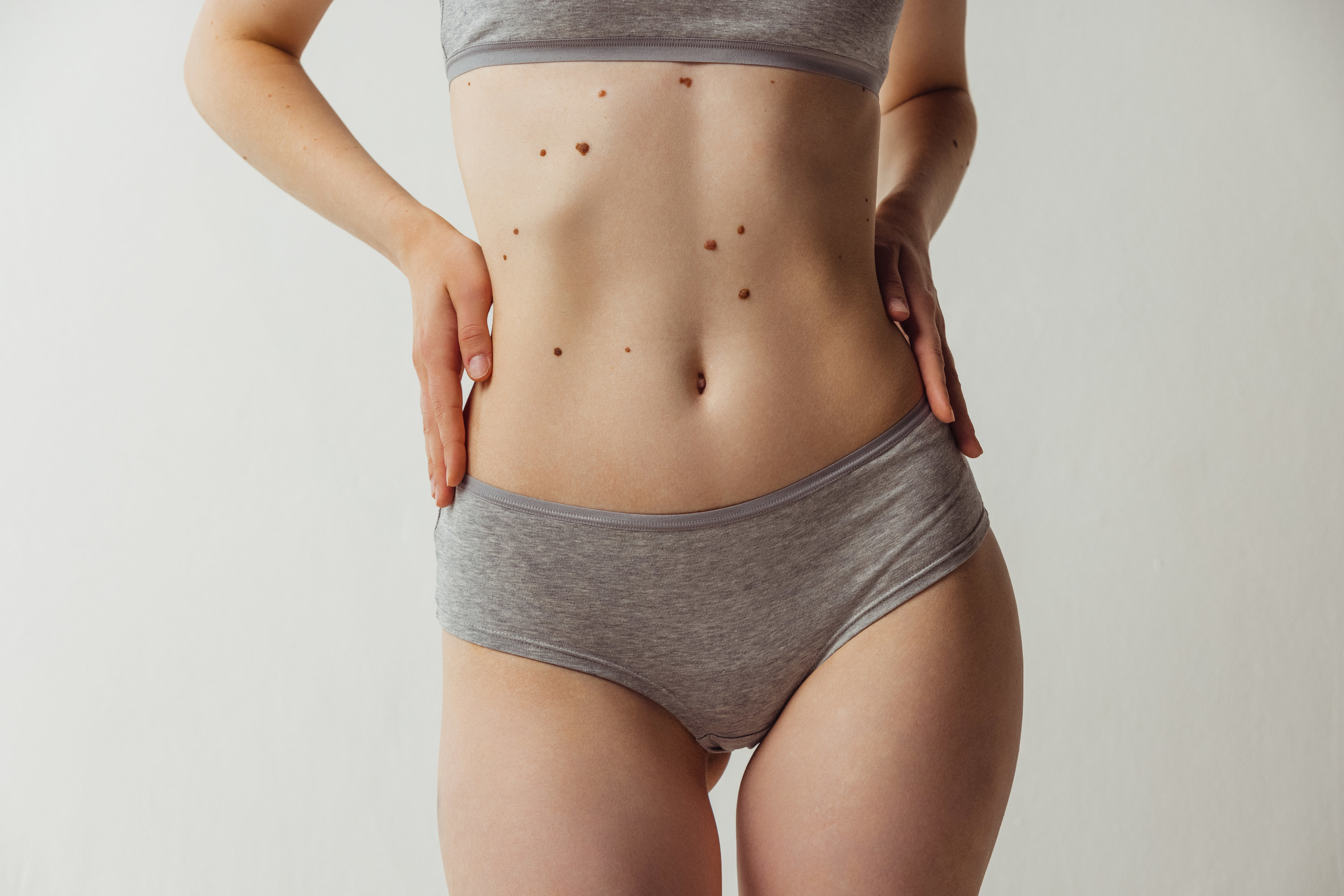 A woman with moles on her body