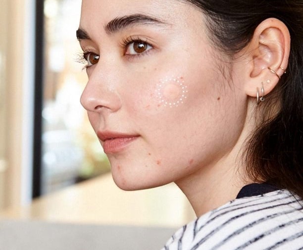 model with the clear pimple patch on cheek showing it working to pull out fluid