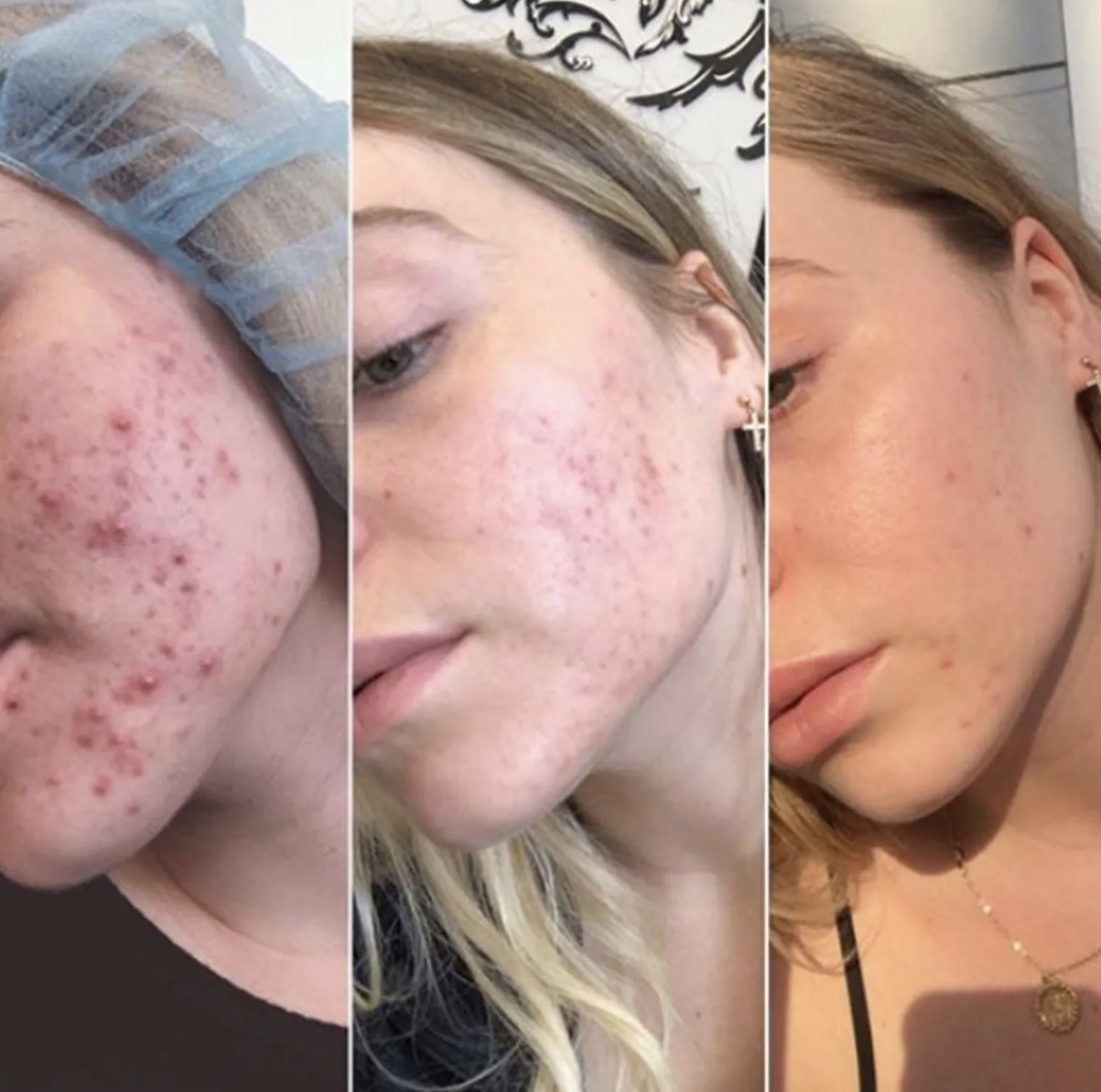 a before and after of a person using the exfoliant
