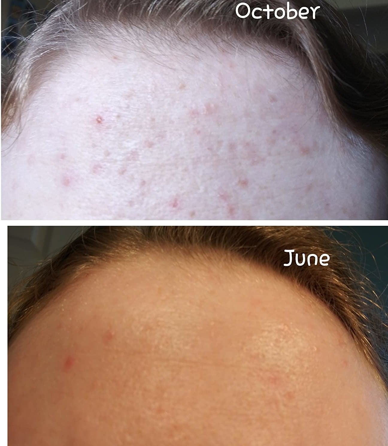a reviewer&#x27;s forehead before and after using this cleanser for seven months