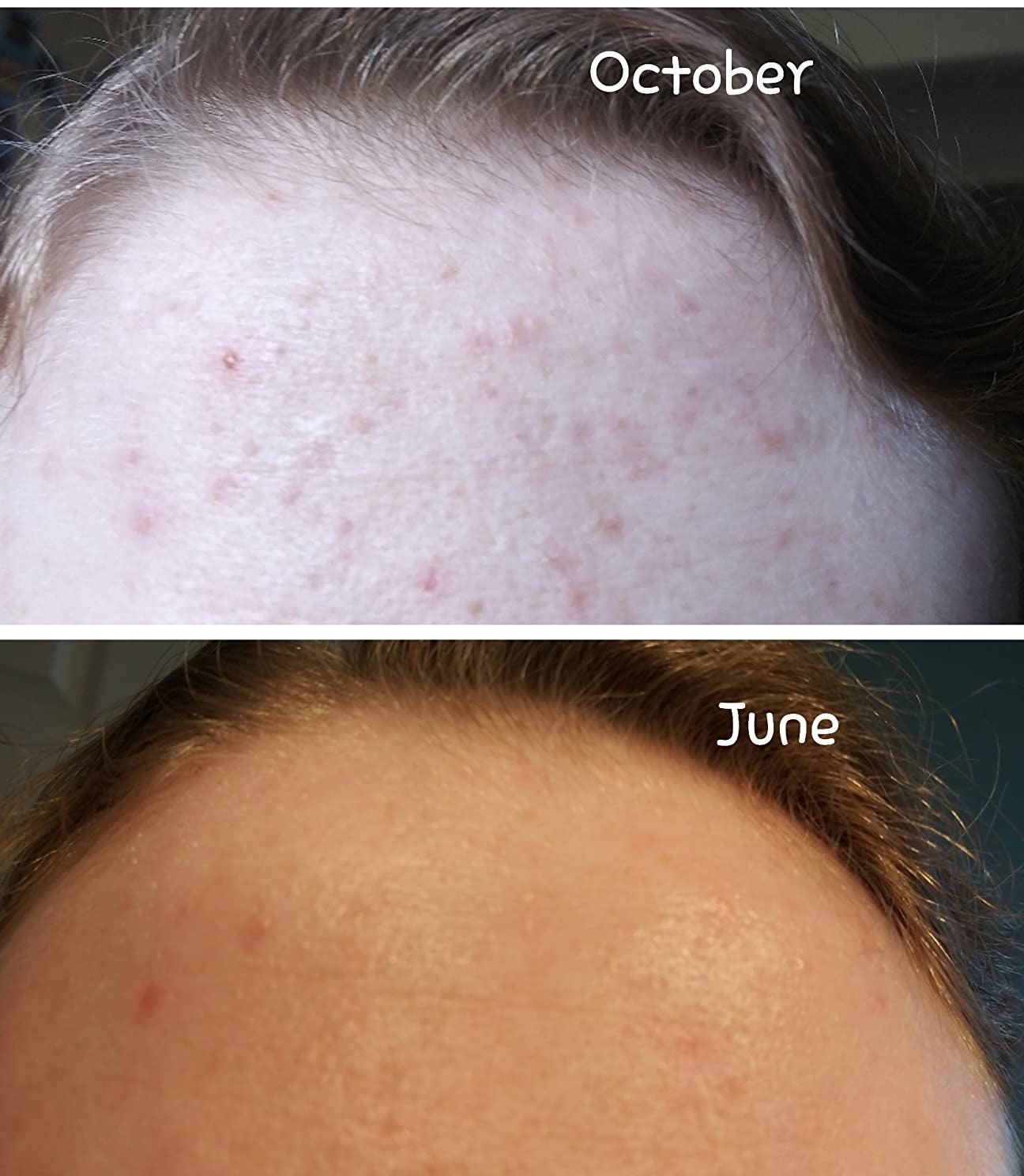 a reviewer&#x27;s forehead before and after using this cleanser for seven months