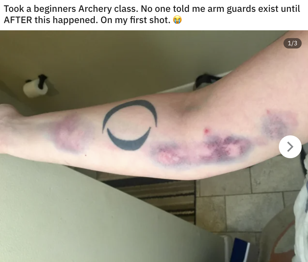 a person&#x27;s arm covered in bruises