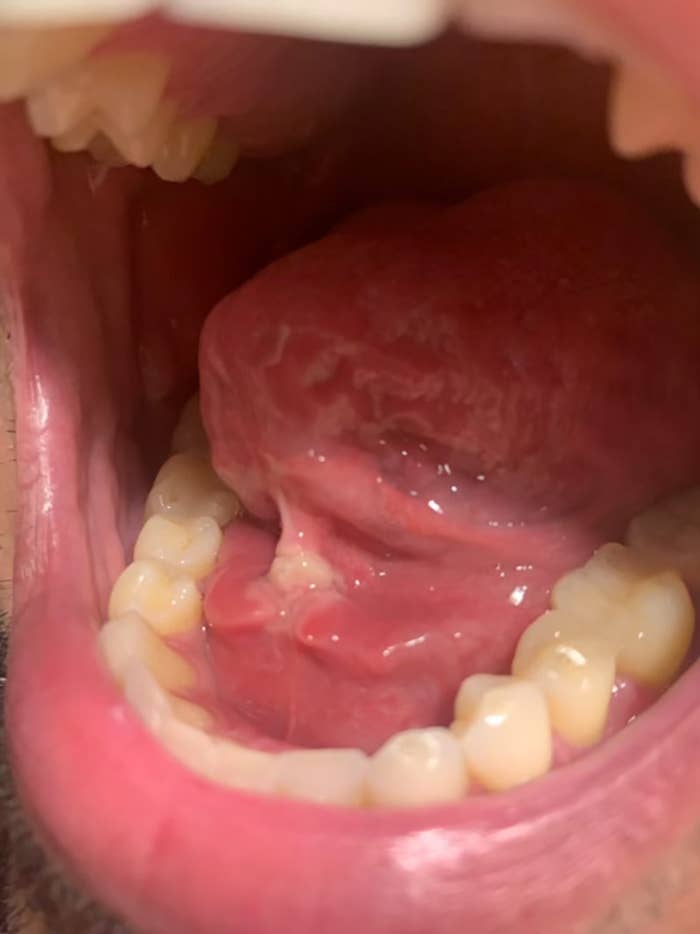 A close-up of someone&#x27;s mouth shows a white sore under their tongue