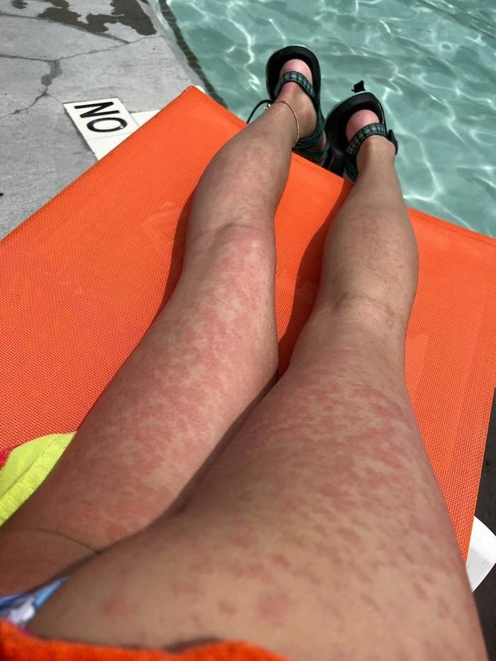 A picture of swimmer&#x27;s itch on a young woman&#x27;s legs.