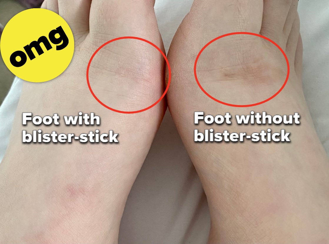 Anti blister balm [Video]