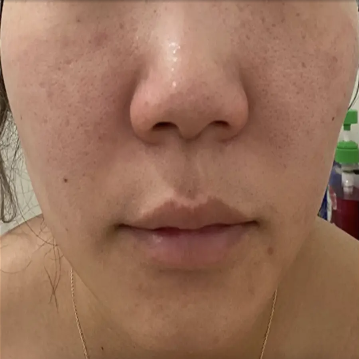 Reviewer before image with redness in skin