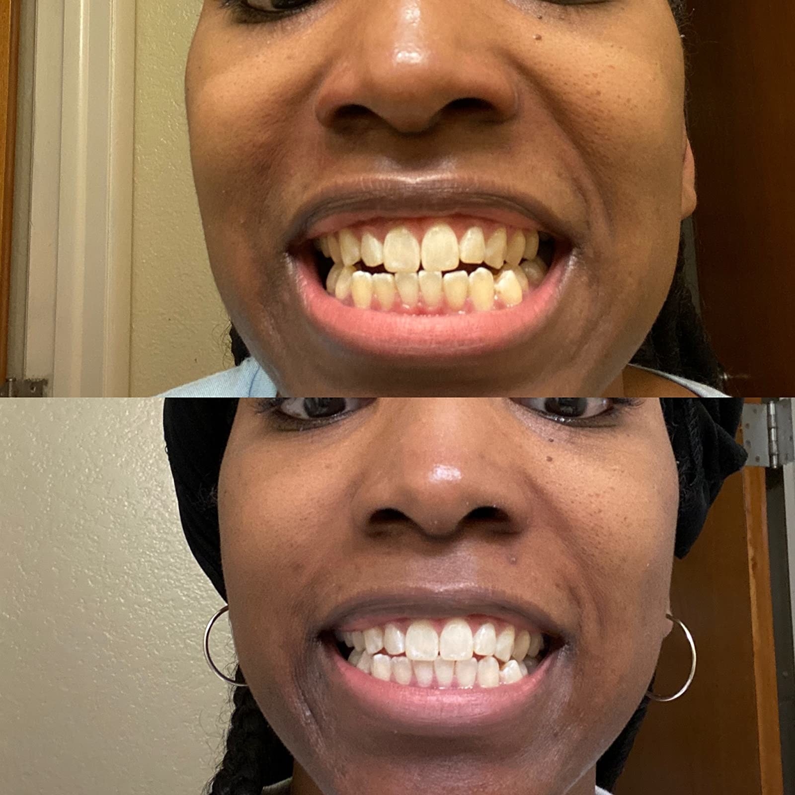 before photo of a reviewer with stained yellow teeth and an after photo showing the whitestrips removed most of the yellow stains