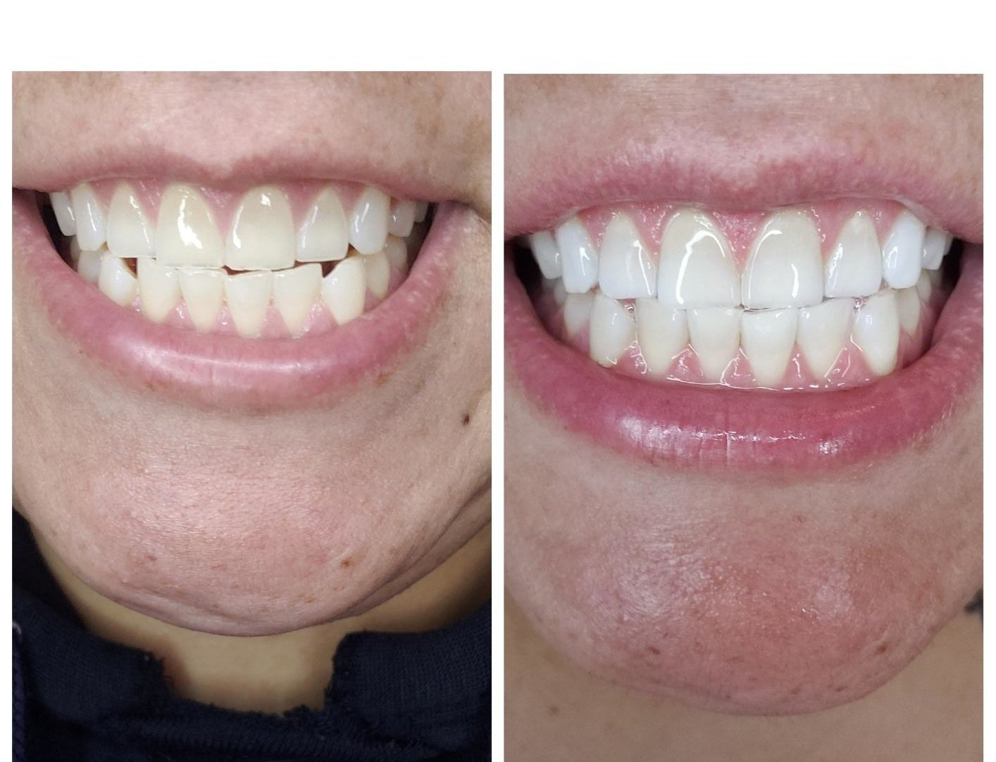 Reviewer&#x27;s teeth before and after using white strips