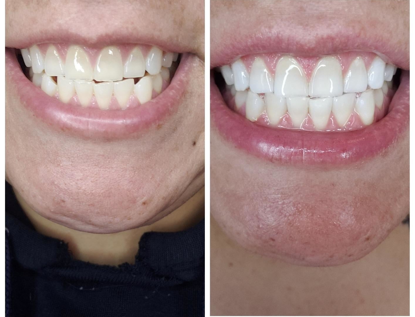 Reviewer&#x27;s teeth before and after using white strips