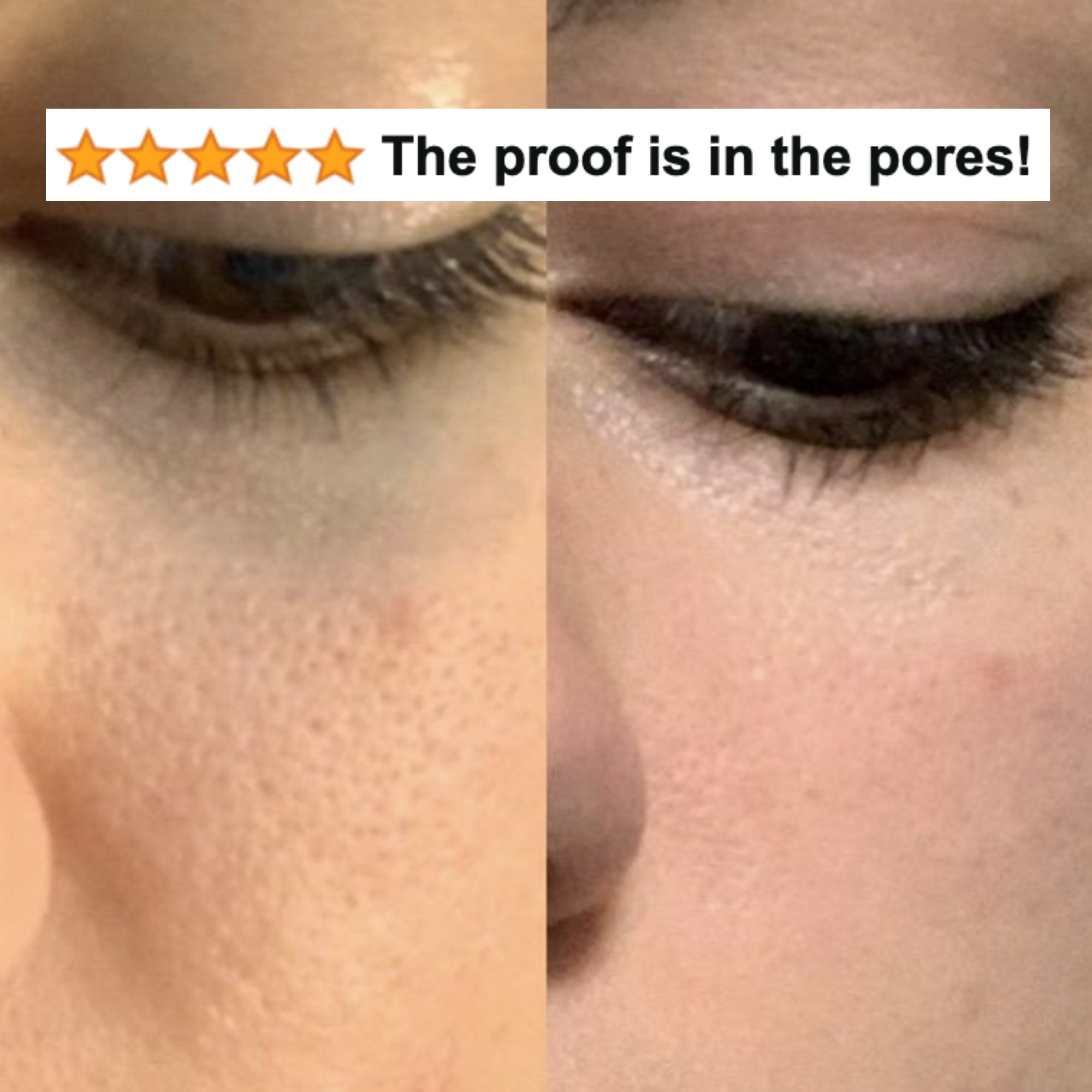 reviewer&#x27;s before and after of prominent pores and then smoother-looking skin