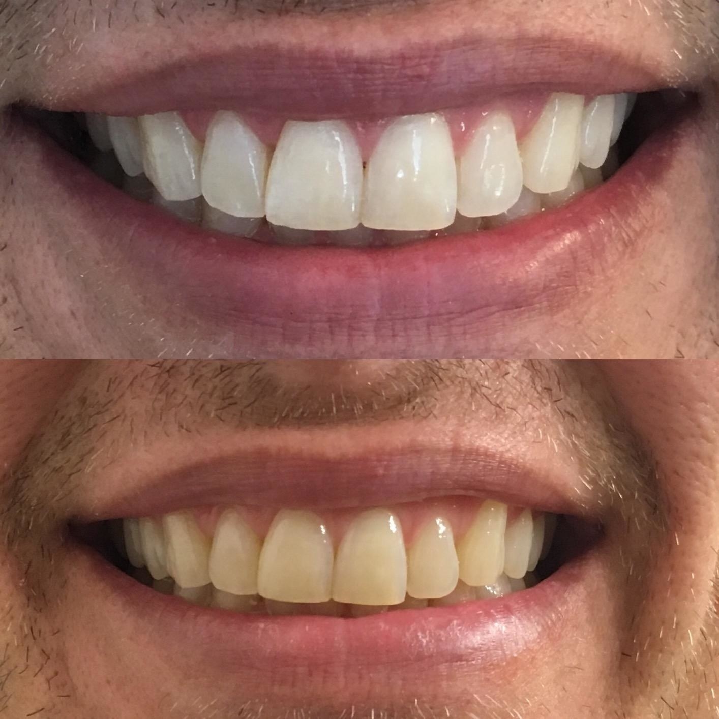 on the top, a reviewer&#x27;s white teeth and, on the bottom, a reviewer&#x27;s teeth appearing yellow before using white strips