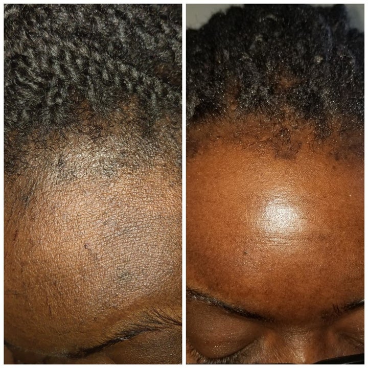 A reviewer with dark skin and their before and after showing the exfoliant brightened dark spots along their hairline and made their skin look bright