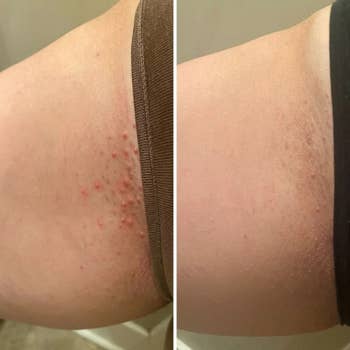 on the left, a reviewer's panty line covered in red bumps and, on the right, the same reviewer with the look of the bumps reduced