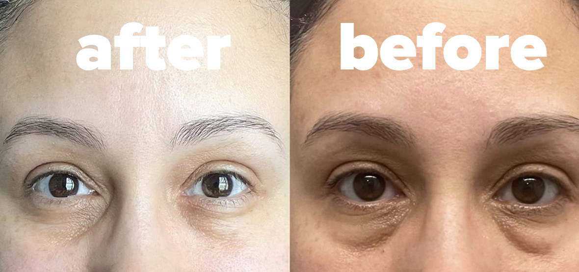 left image is reviewer after using eye cream / right image is before using eye cream with dark circles